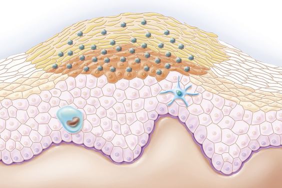 Warts: HPV, Causes, Types, Treatments, Removal, Prevention